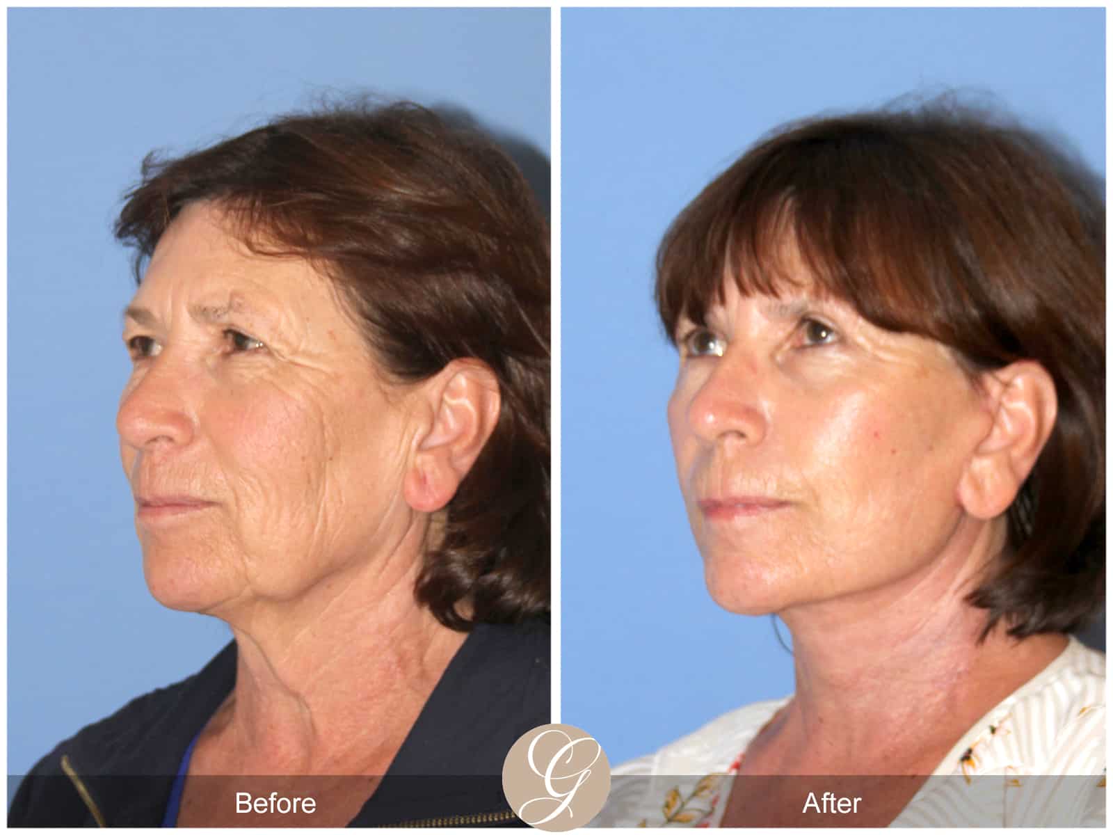 Neck Lift- 410 Image