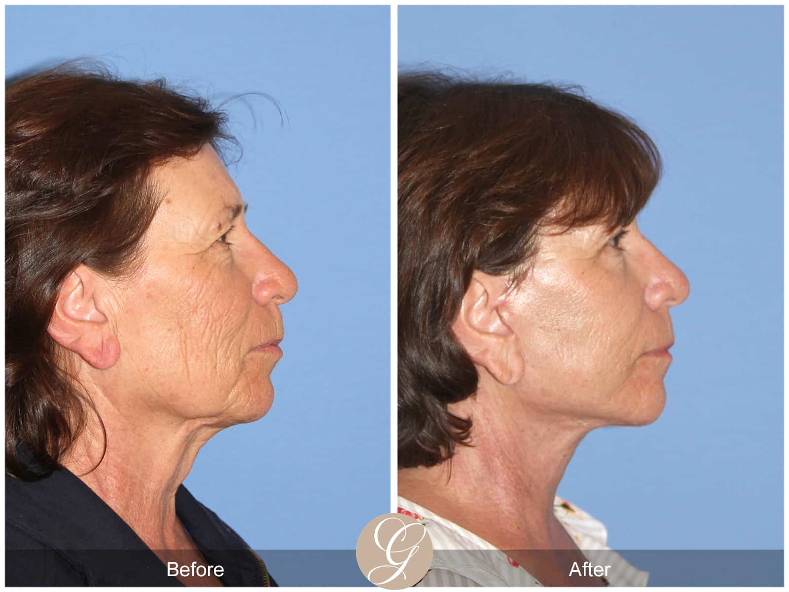 Neck Lift- 410 Image