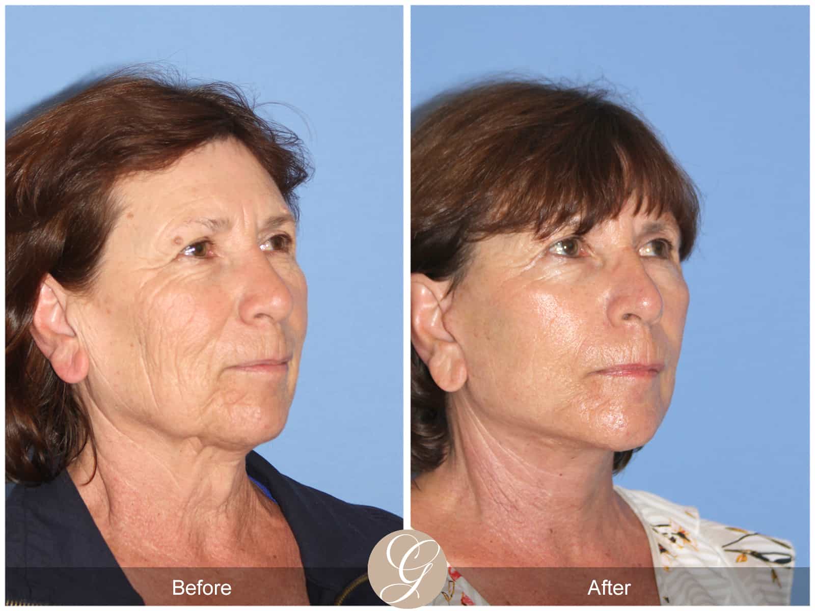 Neck Lift- 410 Image