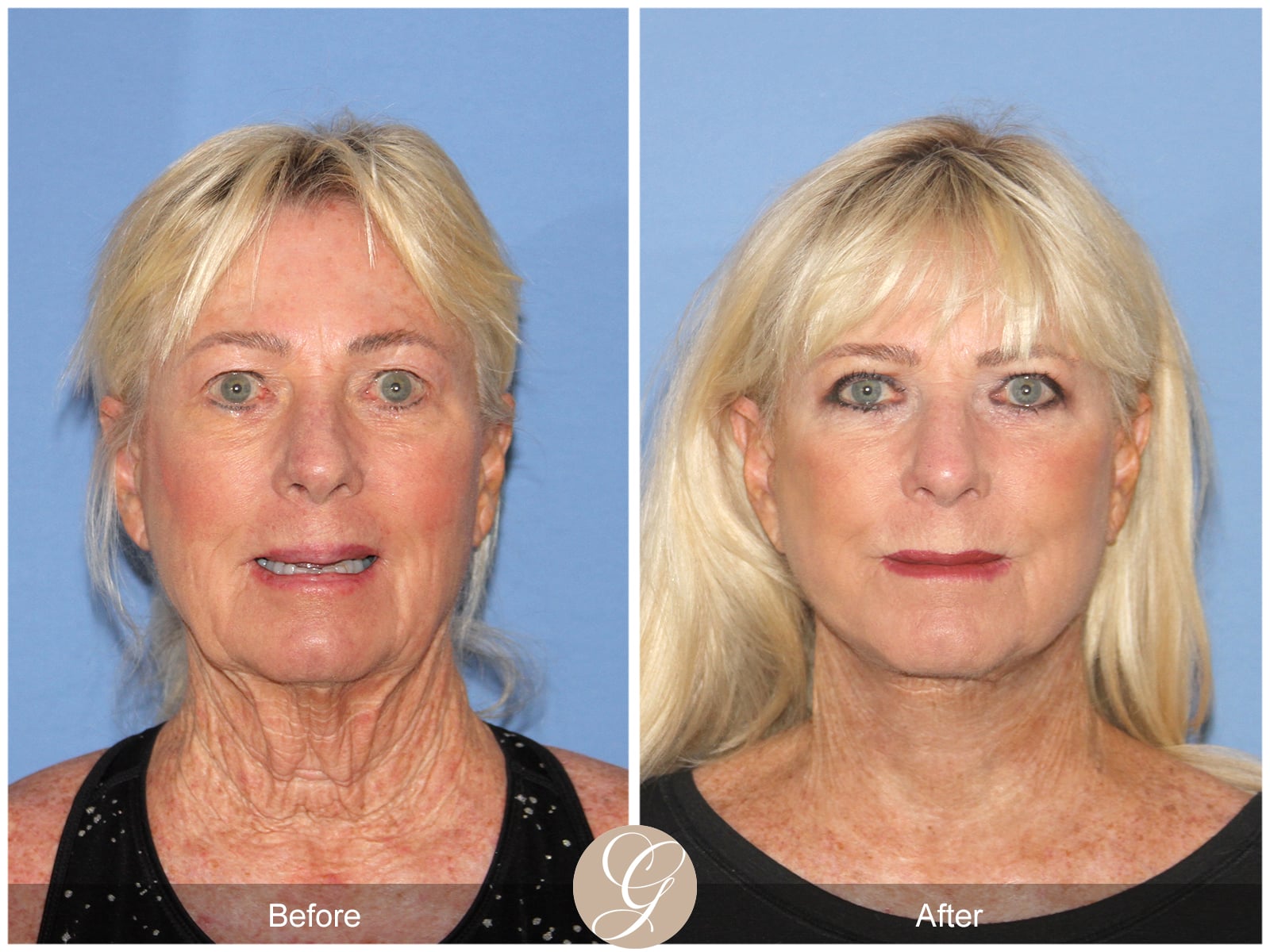 Natural Facelift – 409 Image