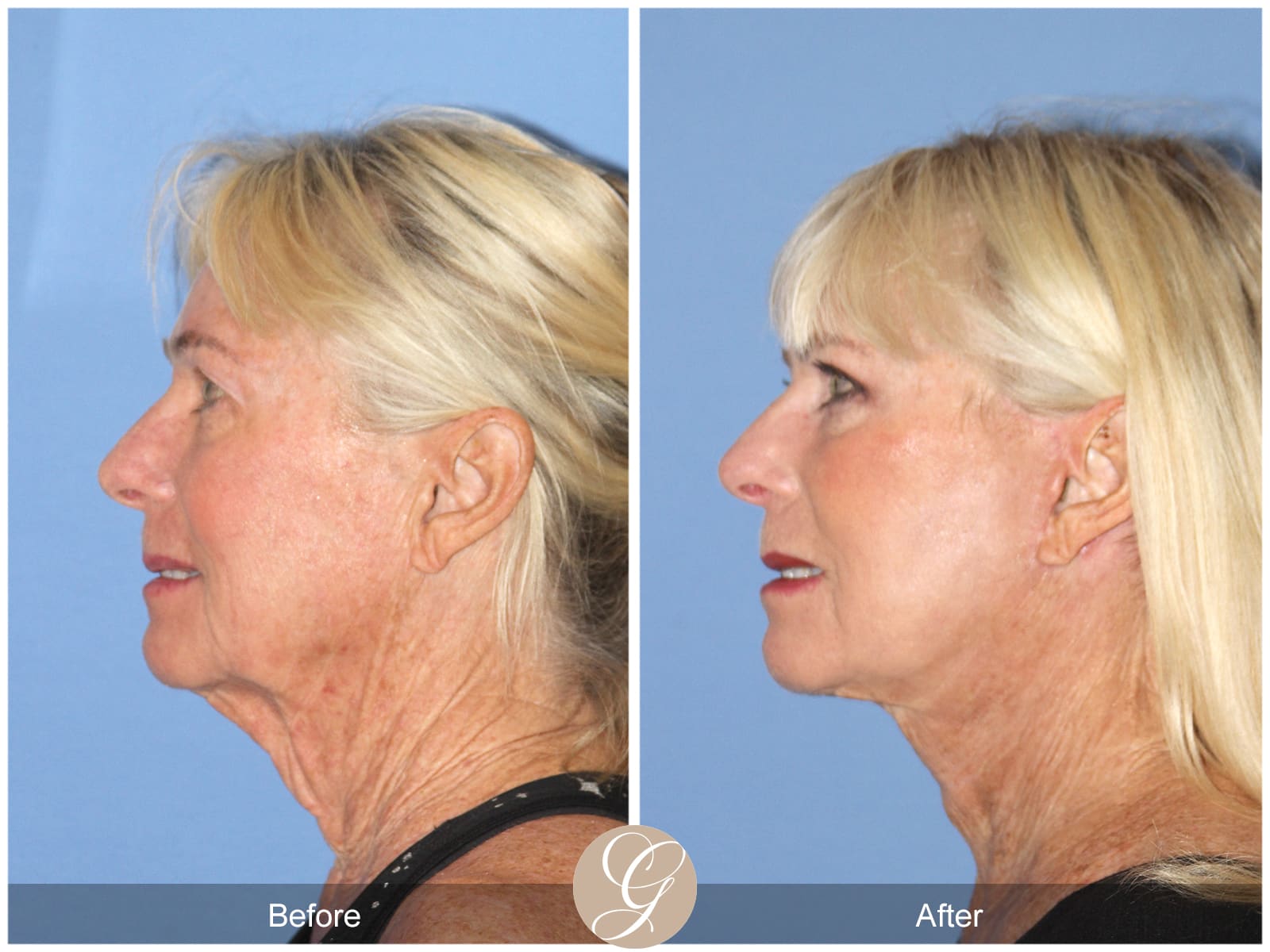 Natural Facelift – 409 Image