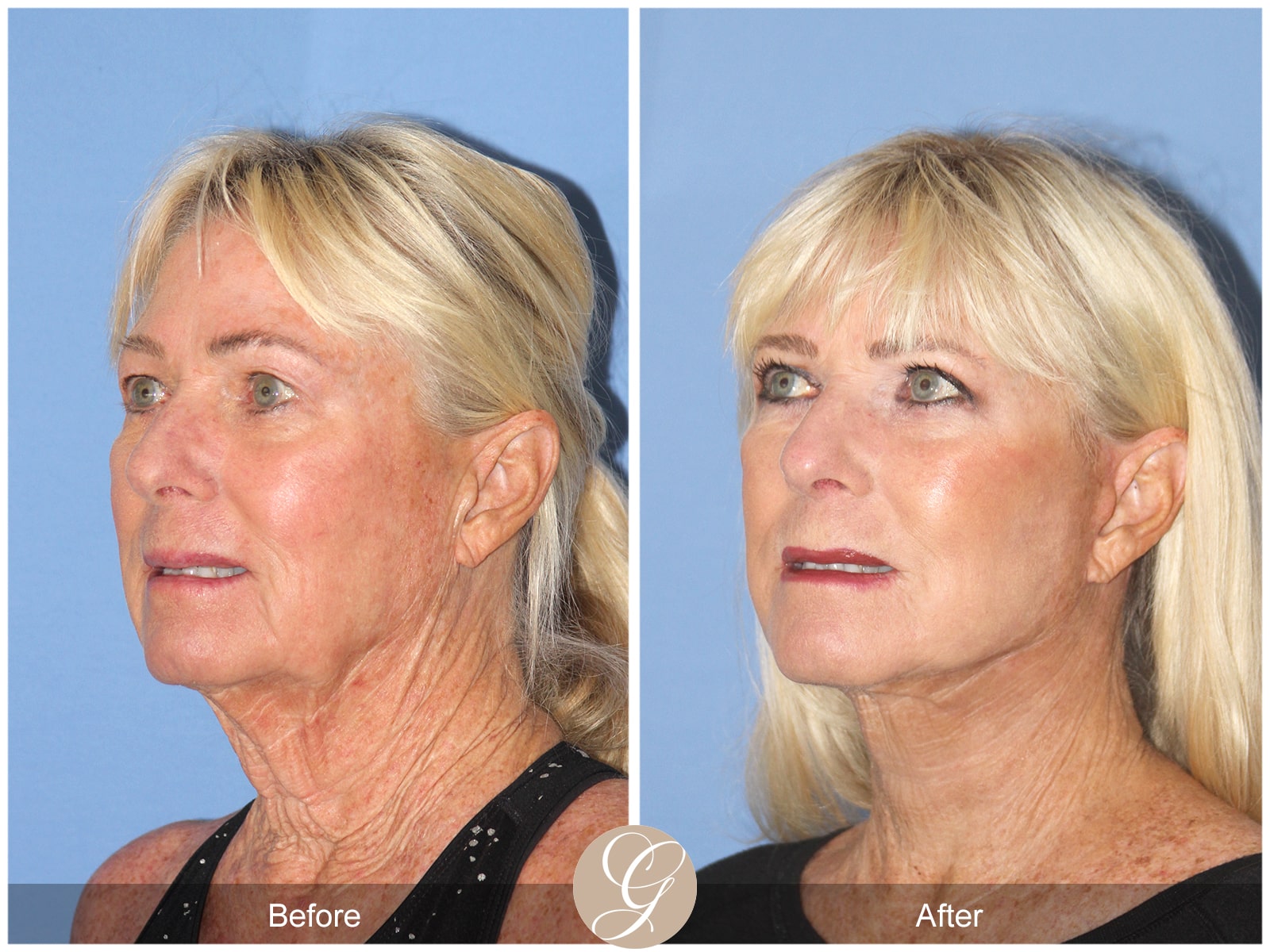 Natural Facelift – 409 Image