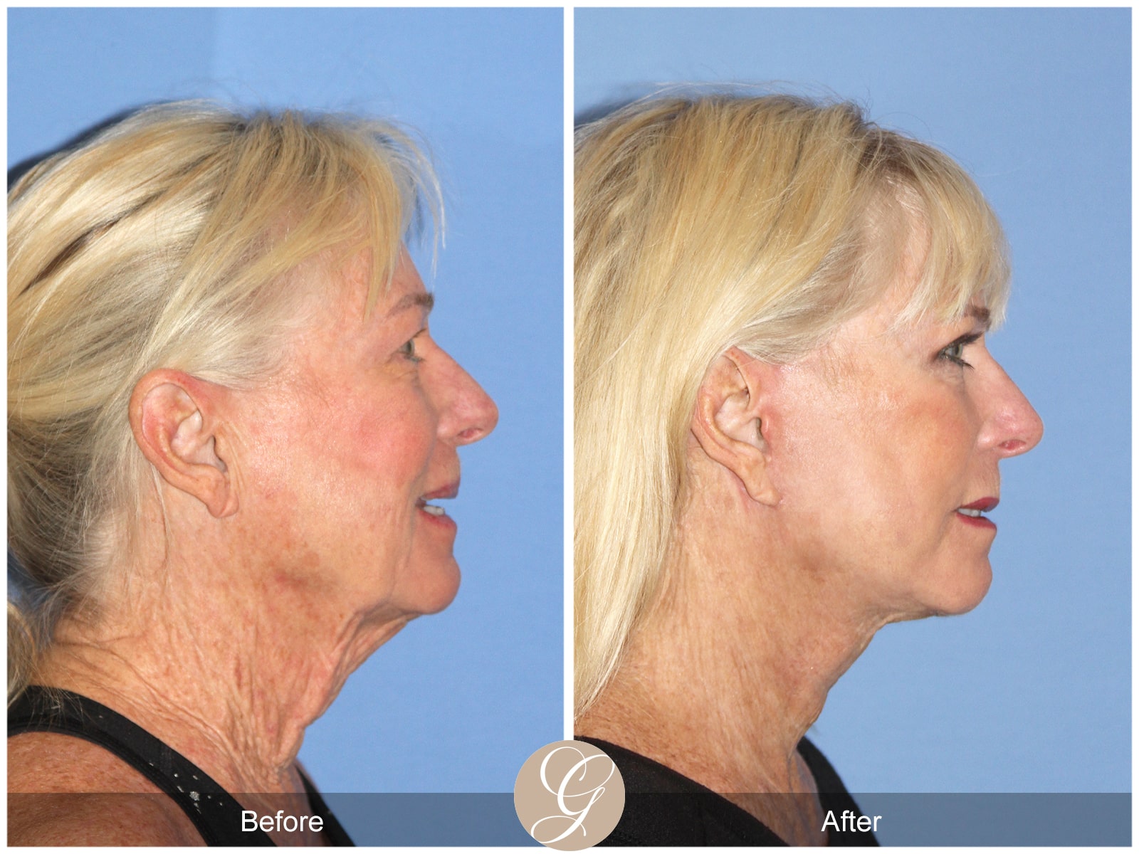 Natural Facelift – 409 Image