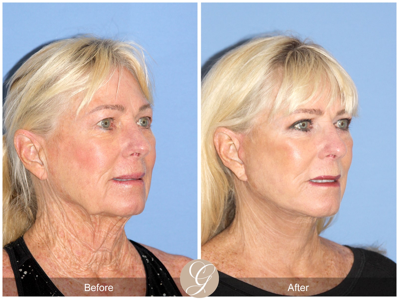 Natural Facelift – 409 Image