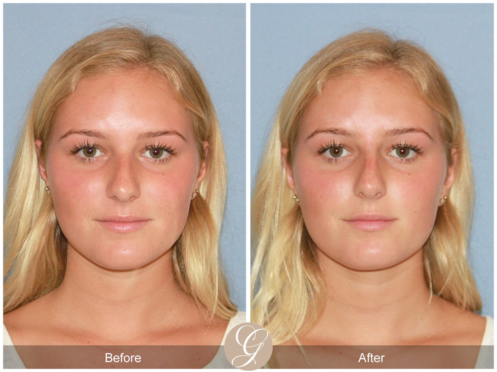 Non-surgical Rhinoplasty 1 Image