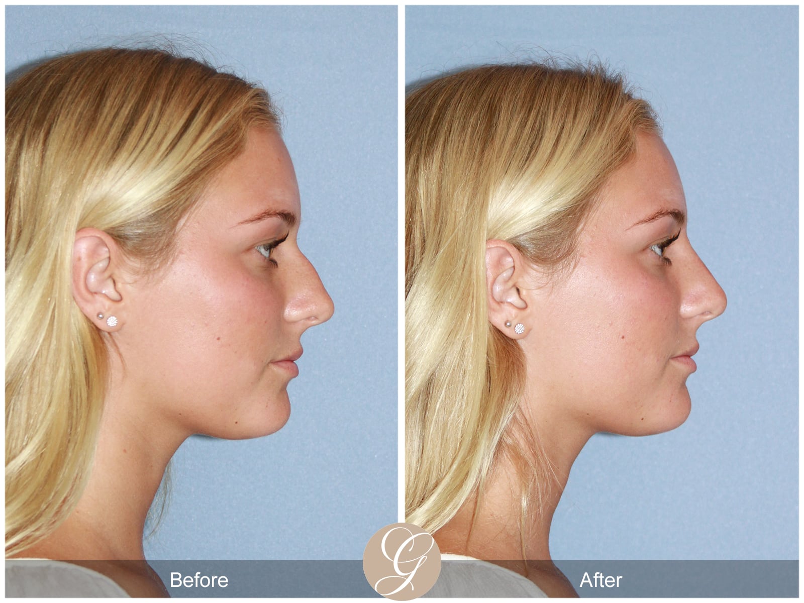 Non-surgical Rhinoplasty 1 Image