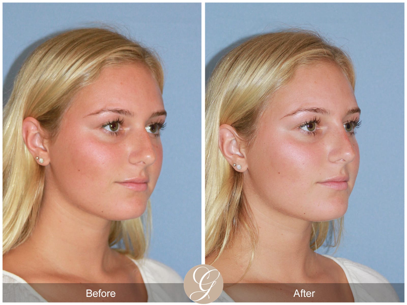 Non-surgical Rhinoplasty 1 Image