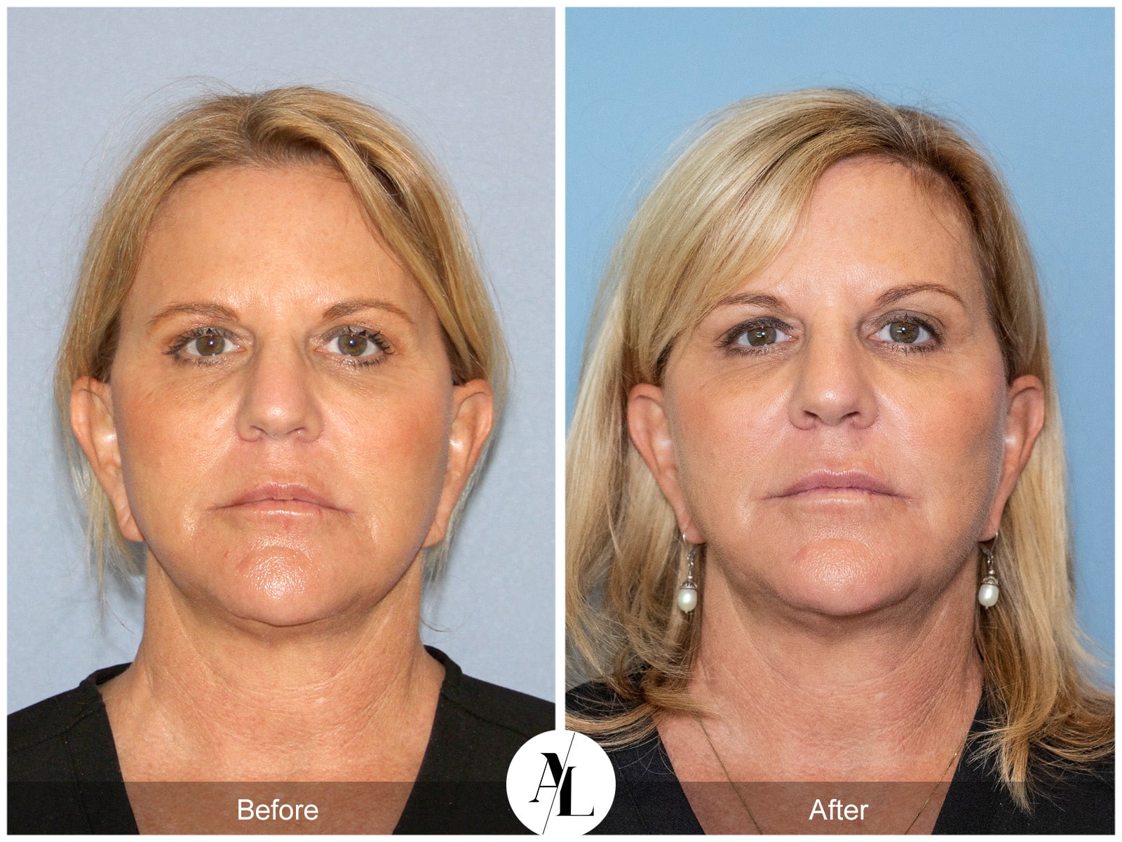 PROFOUND SKIN TIGHTENING-2 Image