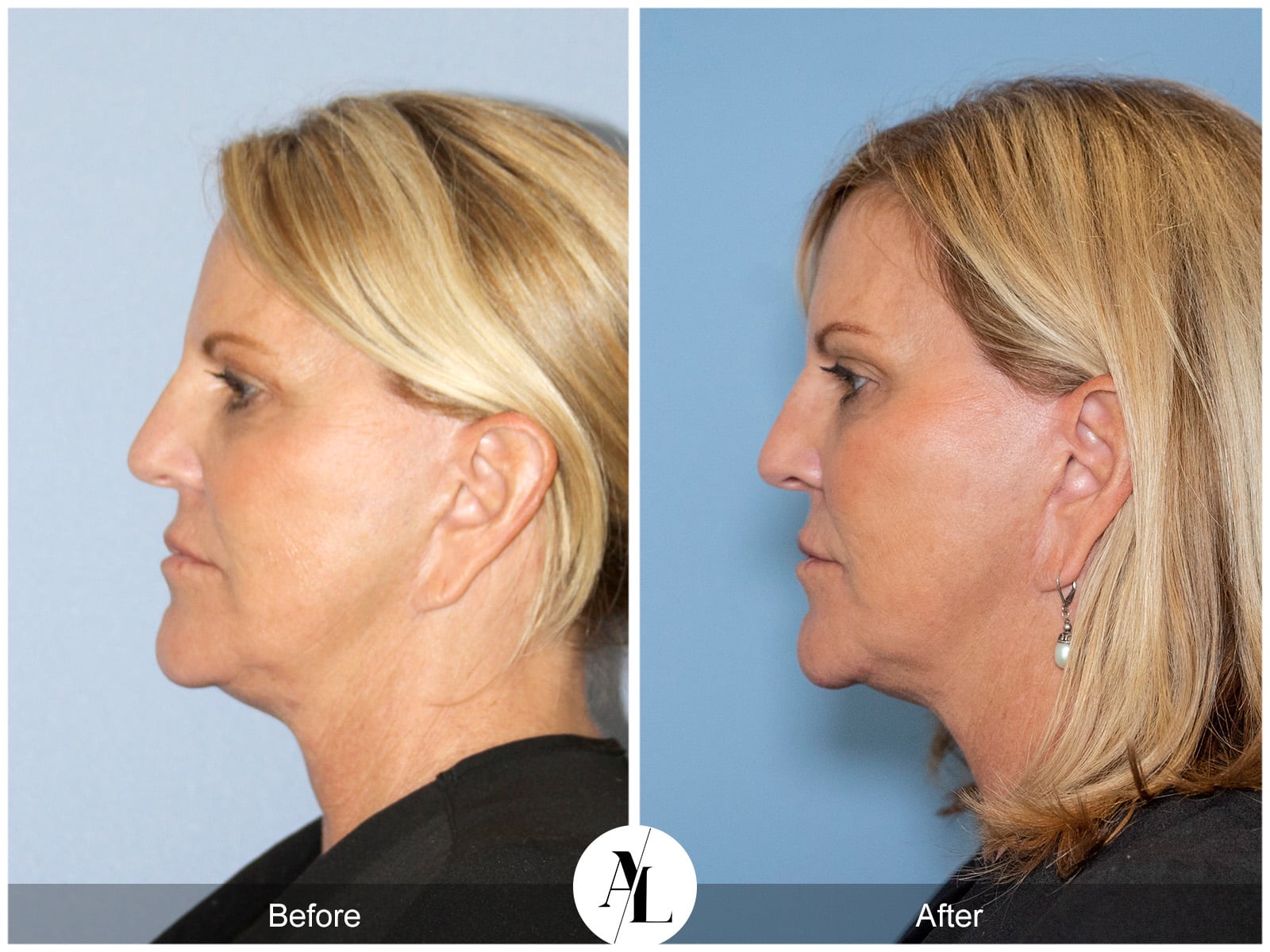 PROFOUND SKIN TIGHTENING-2 Image
