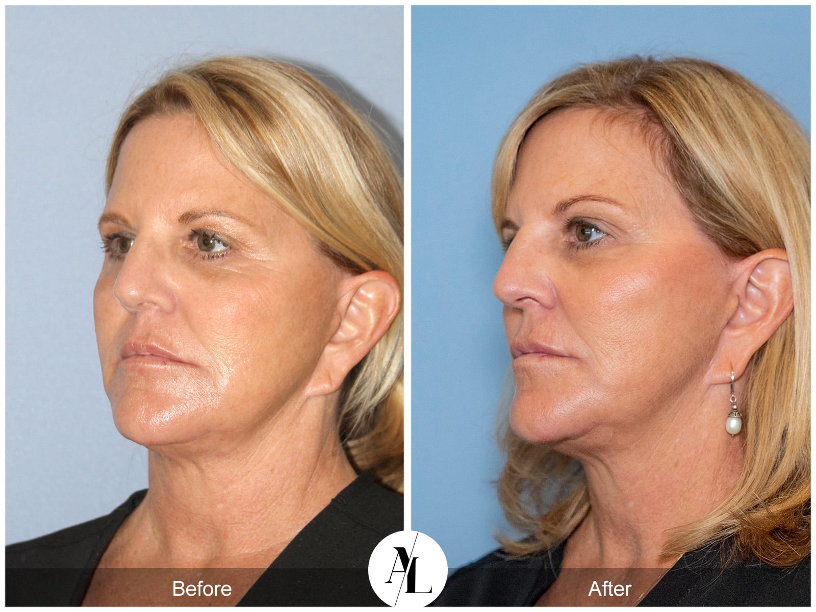 PROFOUND SKIN TIGHTENING-2 Image