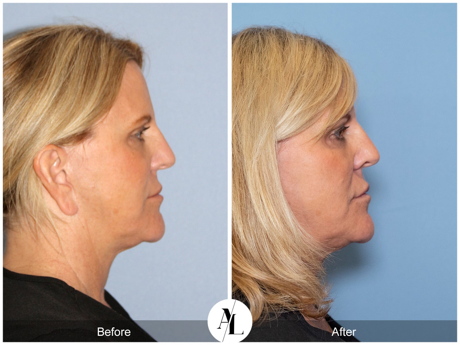 PROFOUND SKIN TIGHTENING-2 Image