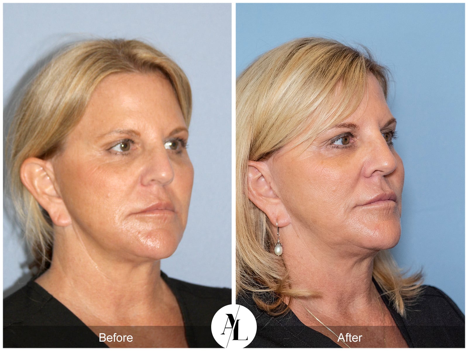PROFOUND SKIN TIGHTENING-2 Image