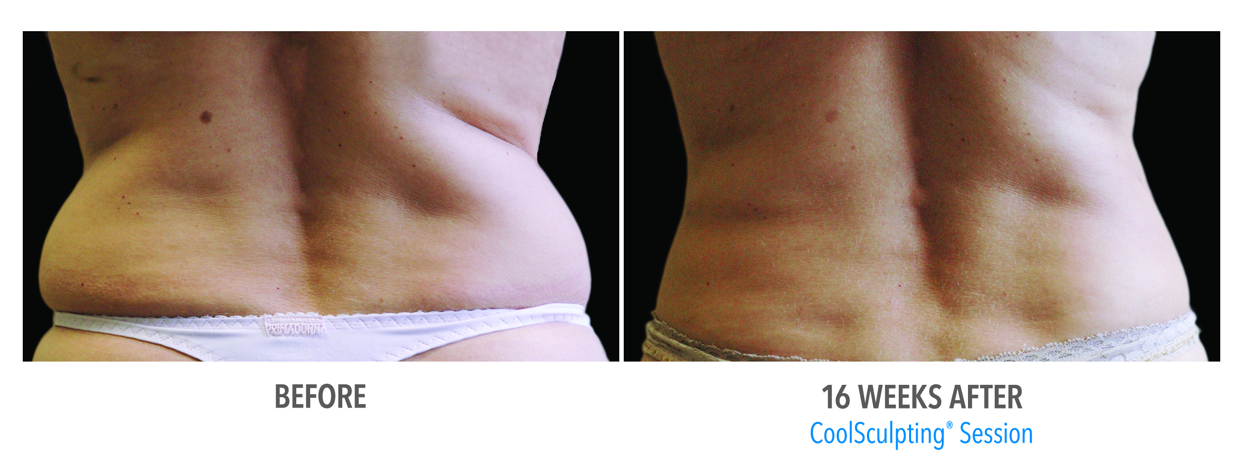 Coolsculpting Case 10 Image