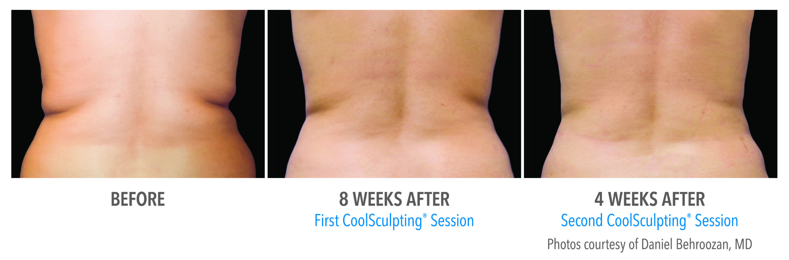 Coolsculpting Case 11 Image