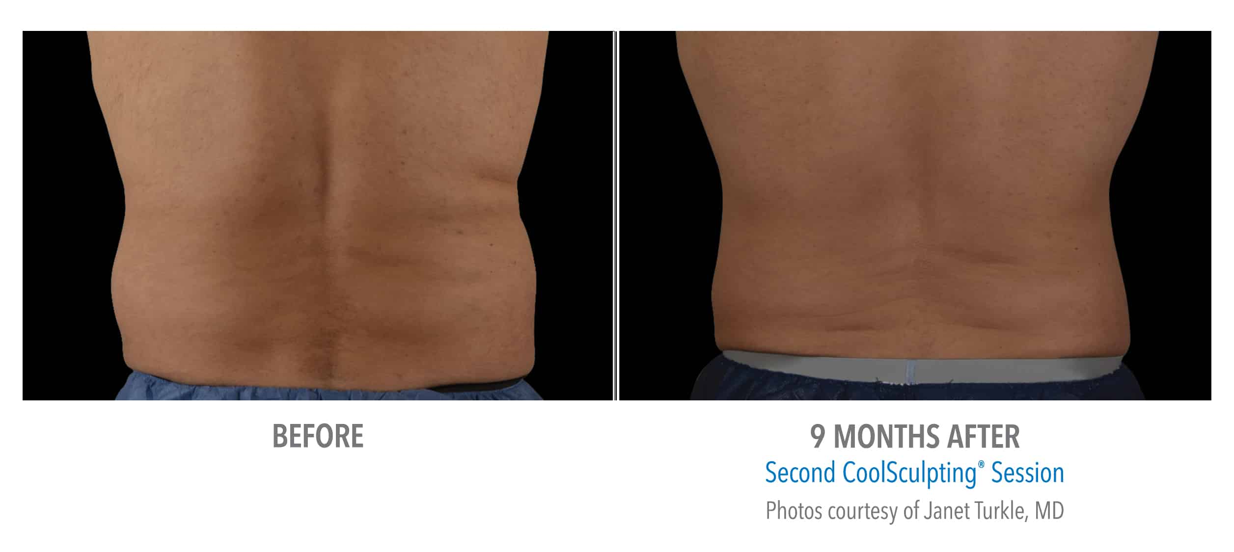 Coolsculpting 12 Image