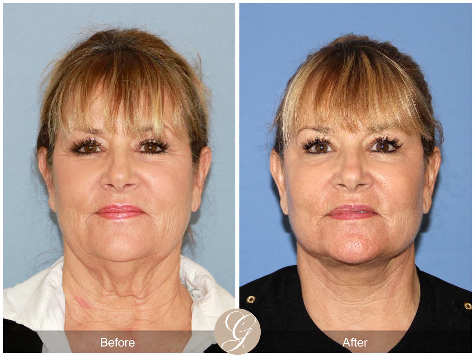 Face and Neck Lift 404 Image