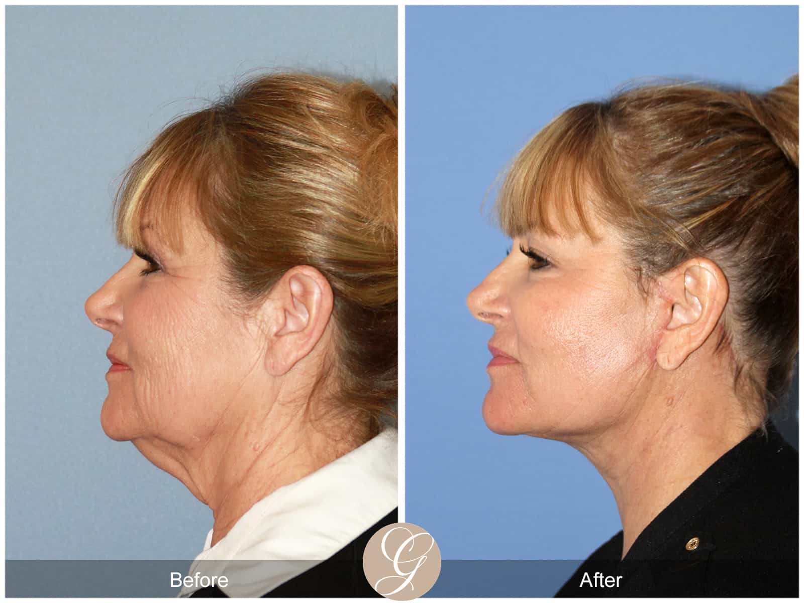 Face and Neck Lift 404 Image