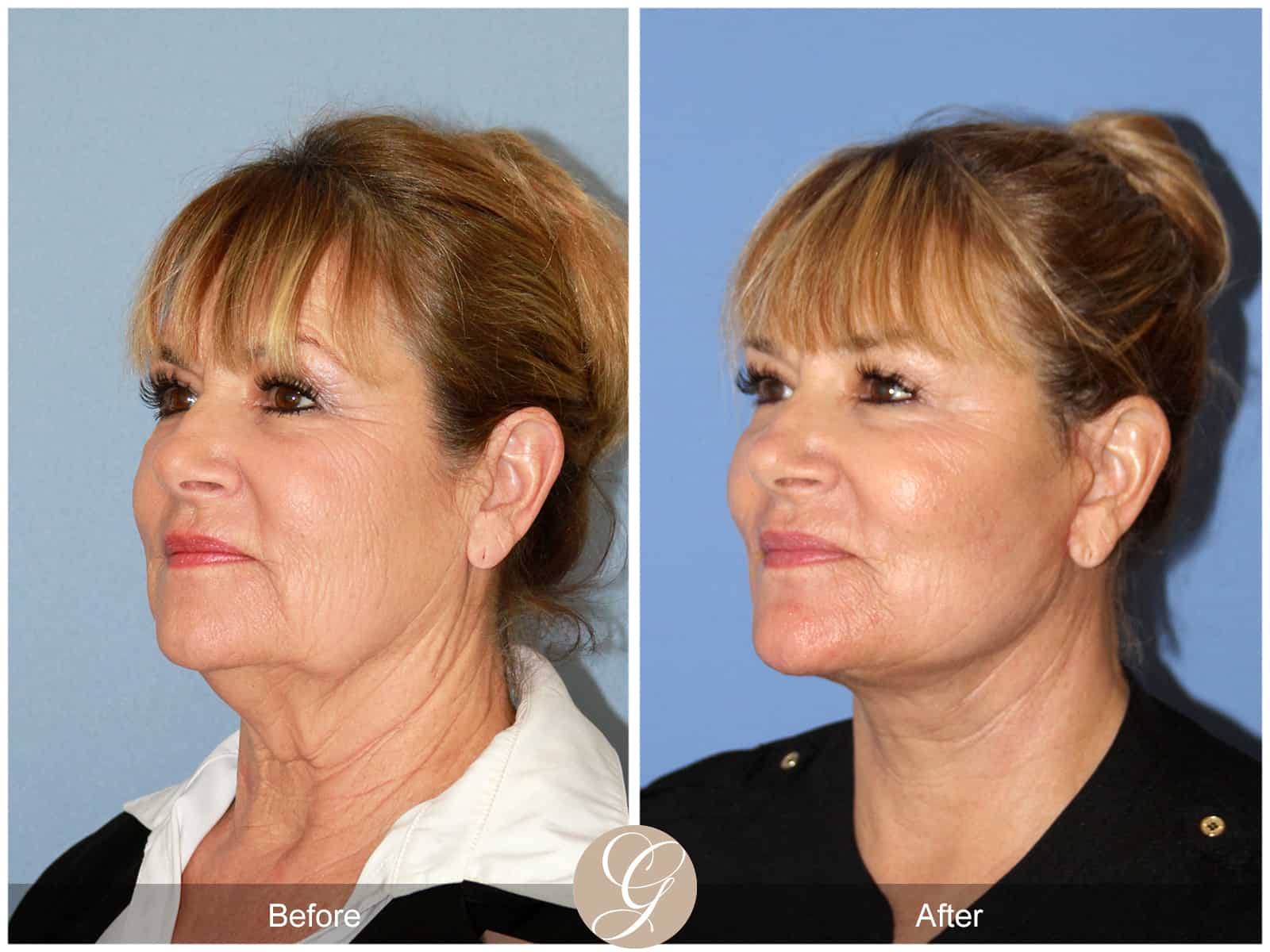 Face and Neck Lift 404 Image