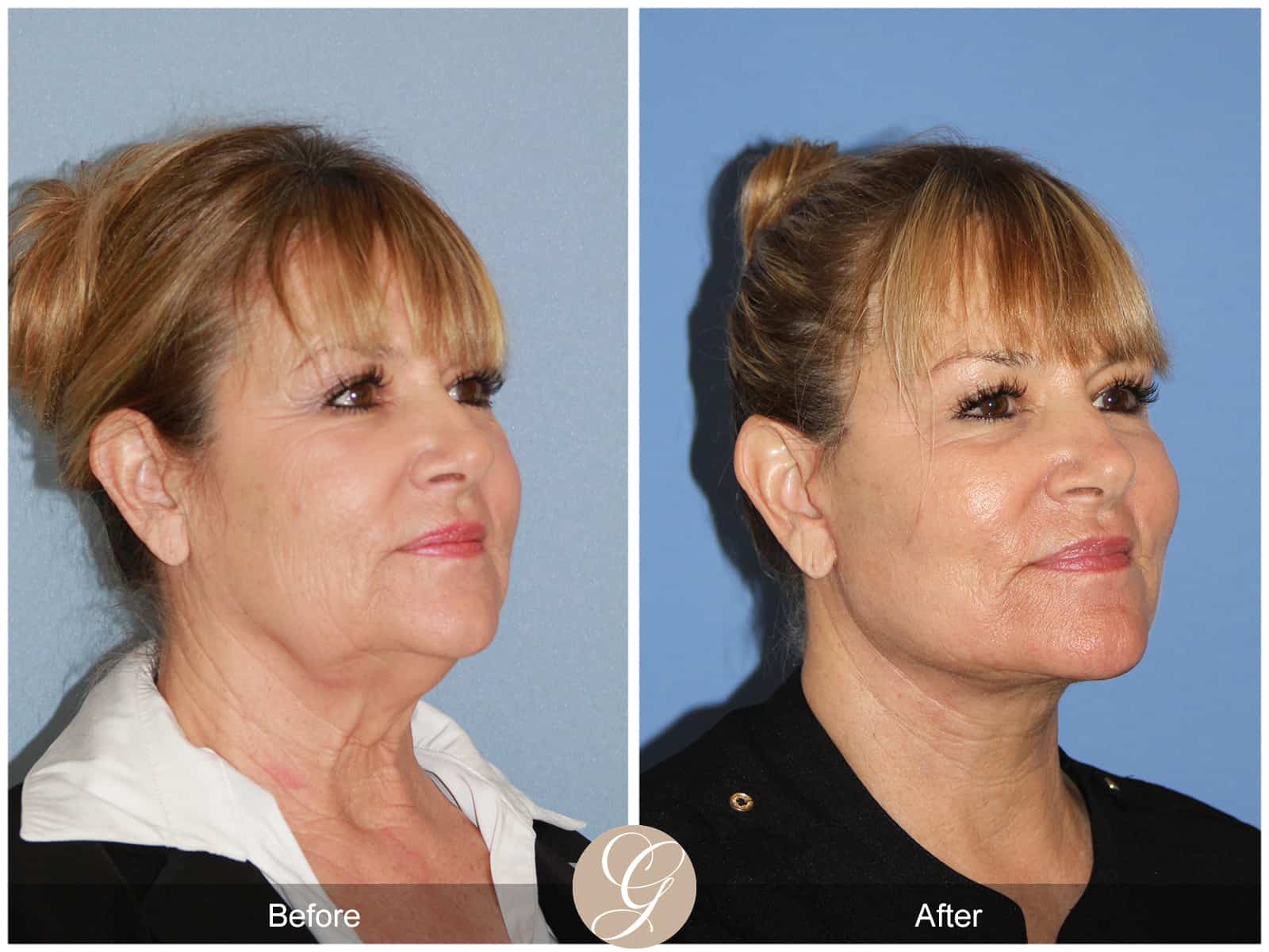 Face and Neck Lift 404 Image