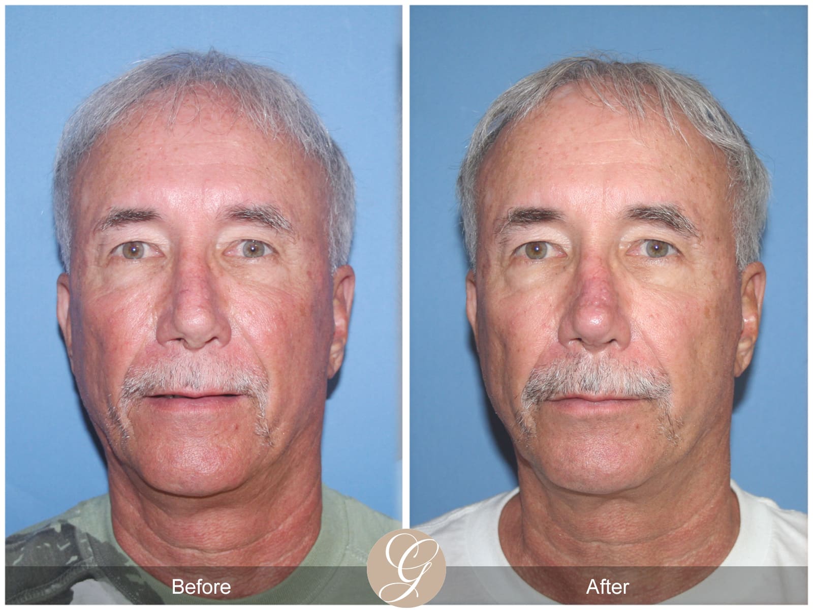 Rhinoplasty 106 Image