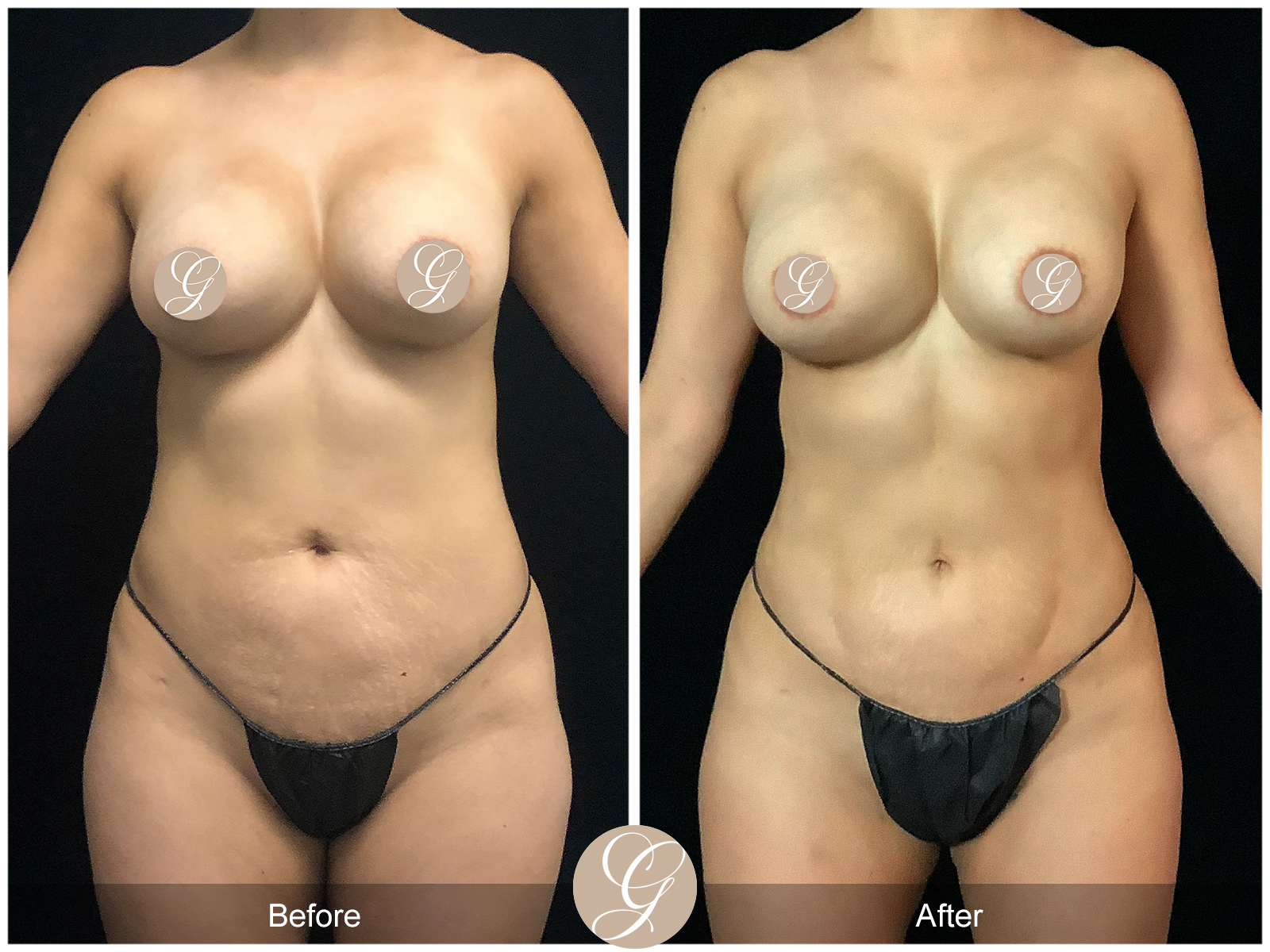 Best High Definition Body Contouring