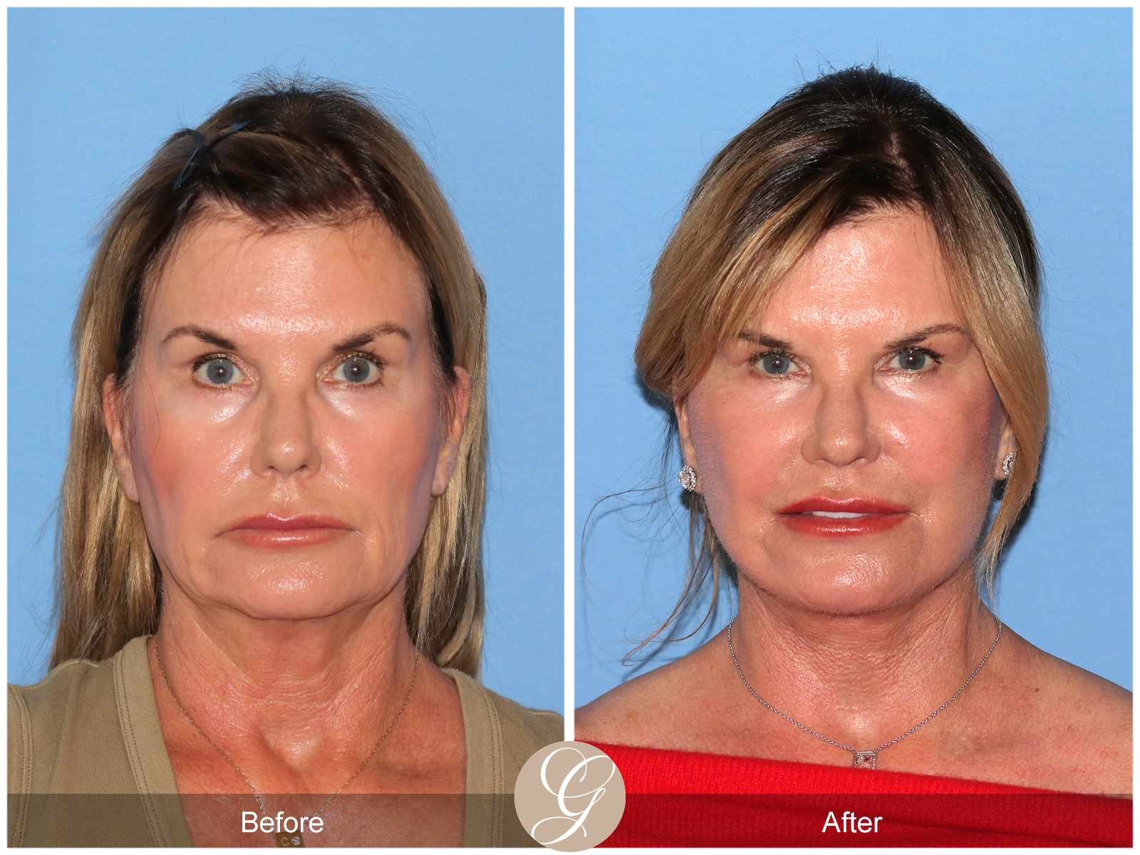 Preservation Facelift Case 7 Image