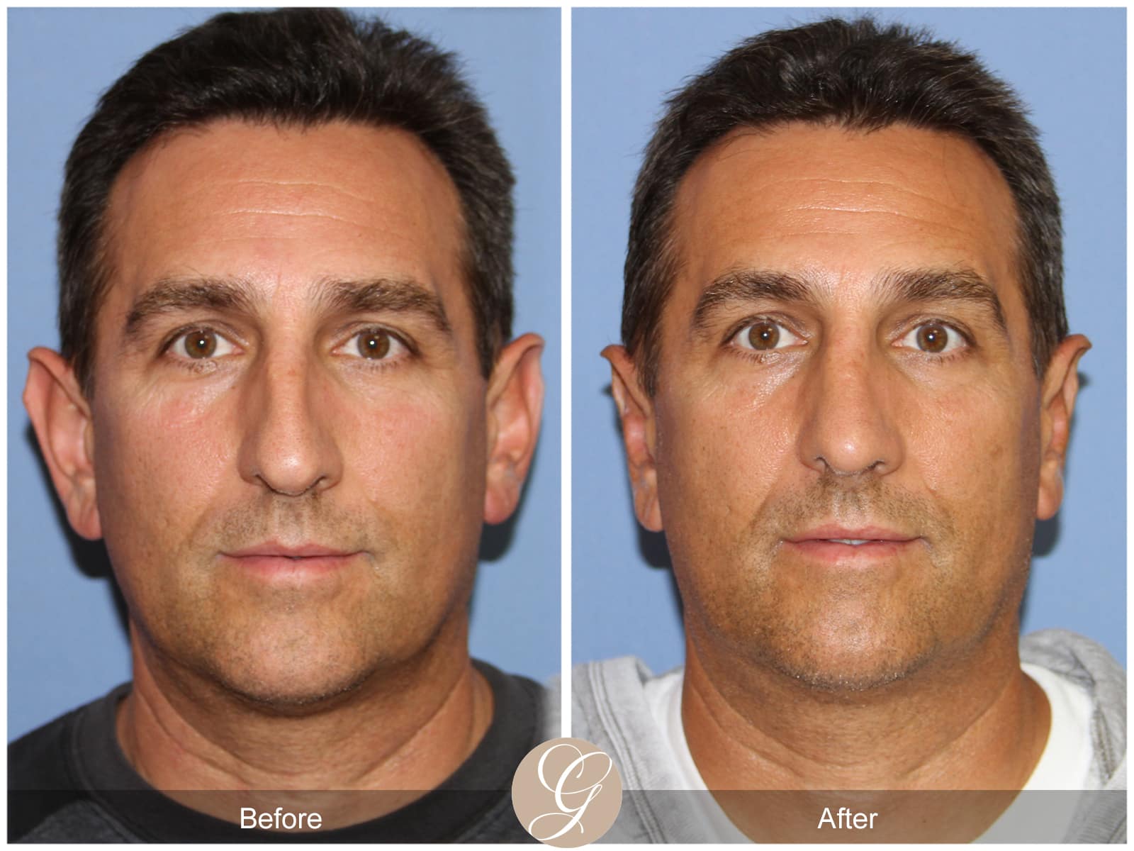 Rhinoplasty 111 Image
