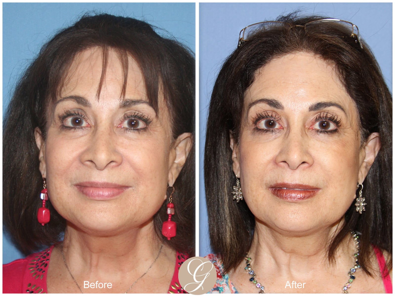 Rhinoplasty 112 Image