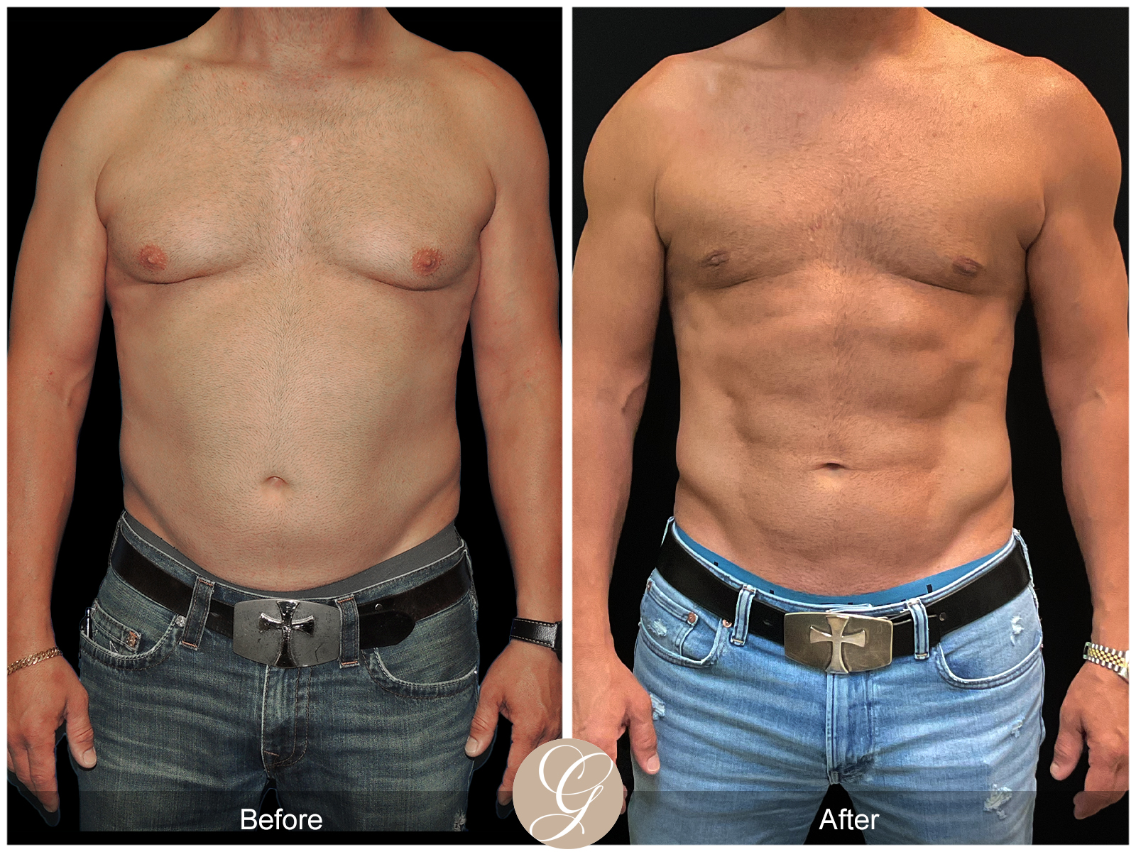 Gynecomastia PT2 Image