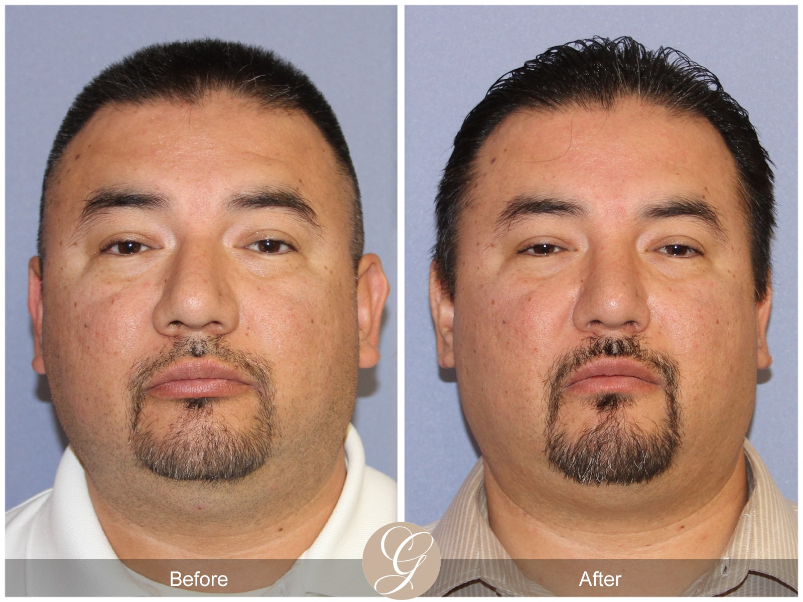 Rhinoplasty 105 Image