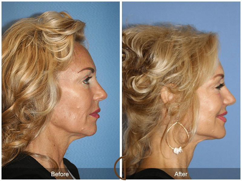 What is the Difference between SMAS vs. Deep Plane Facelift Image
