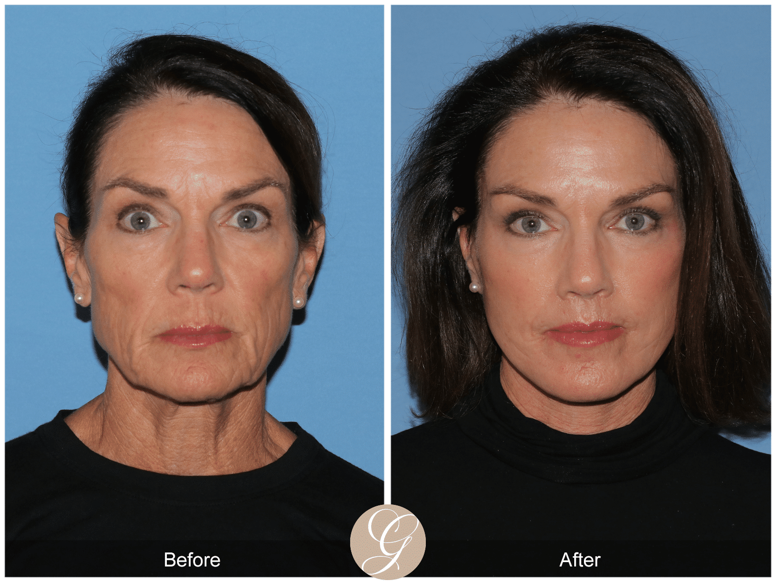 Vertical Facelift in Newport Beach