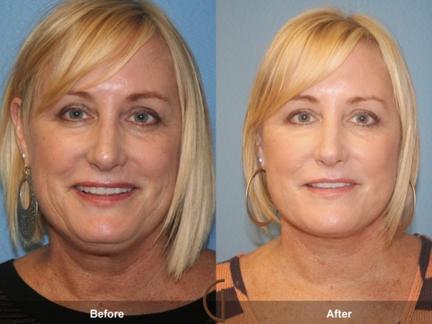 Orange County Neck Liposuction