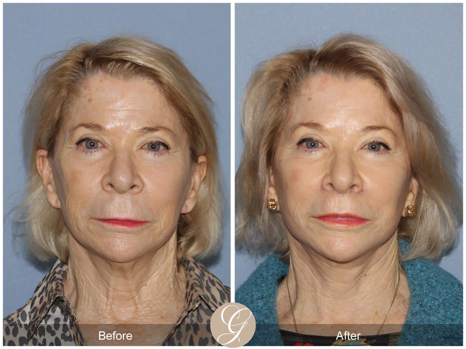 Natural Lift, Lip Lift, CO2 Laser 427 Image