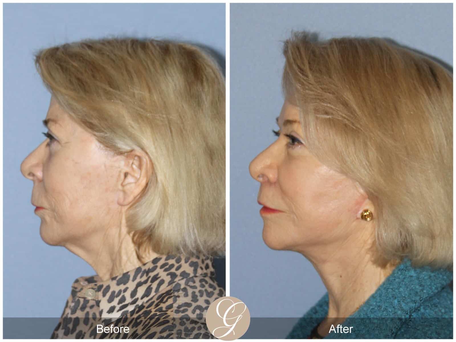 Natural Lift, Lip Lift, CO2 Laser 427 Image