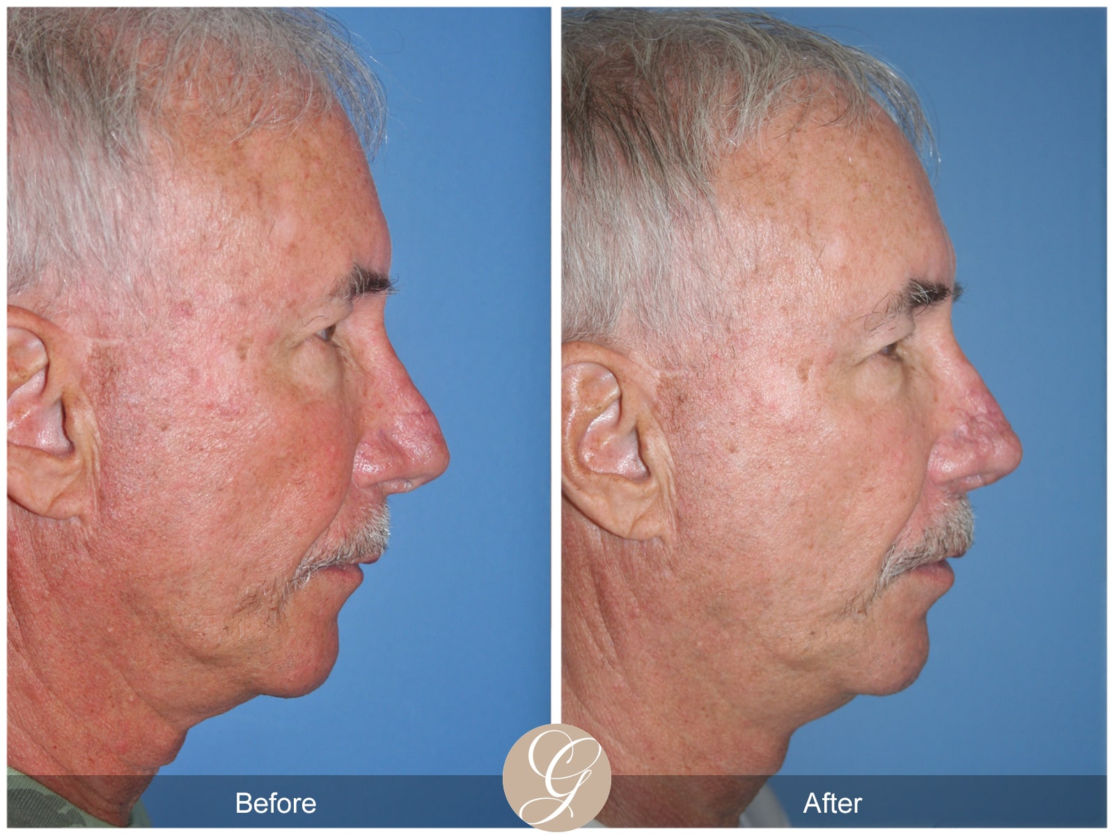 Rhinoplasty 106 Image