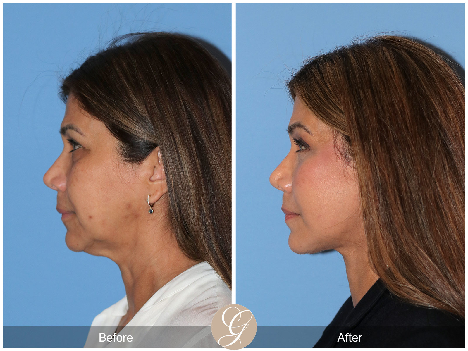 Preservation Facelift Case 14 Image