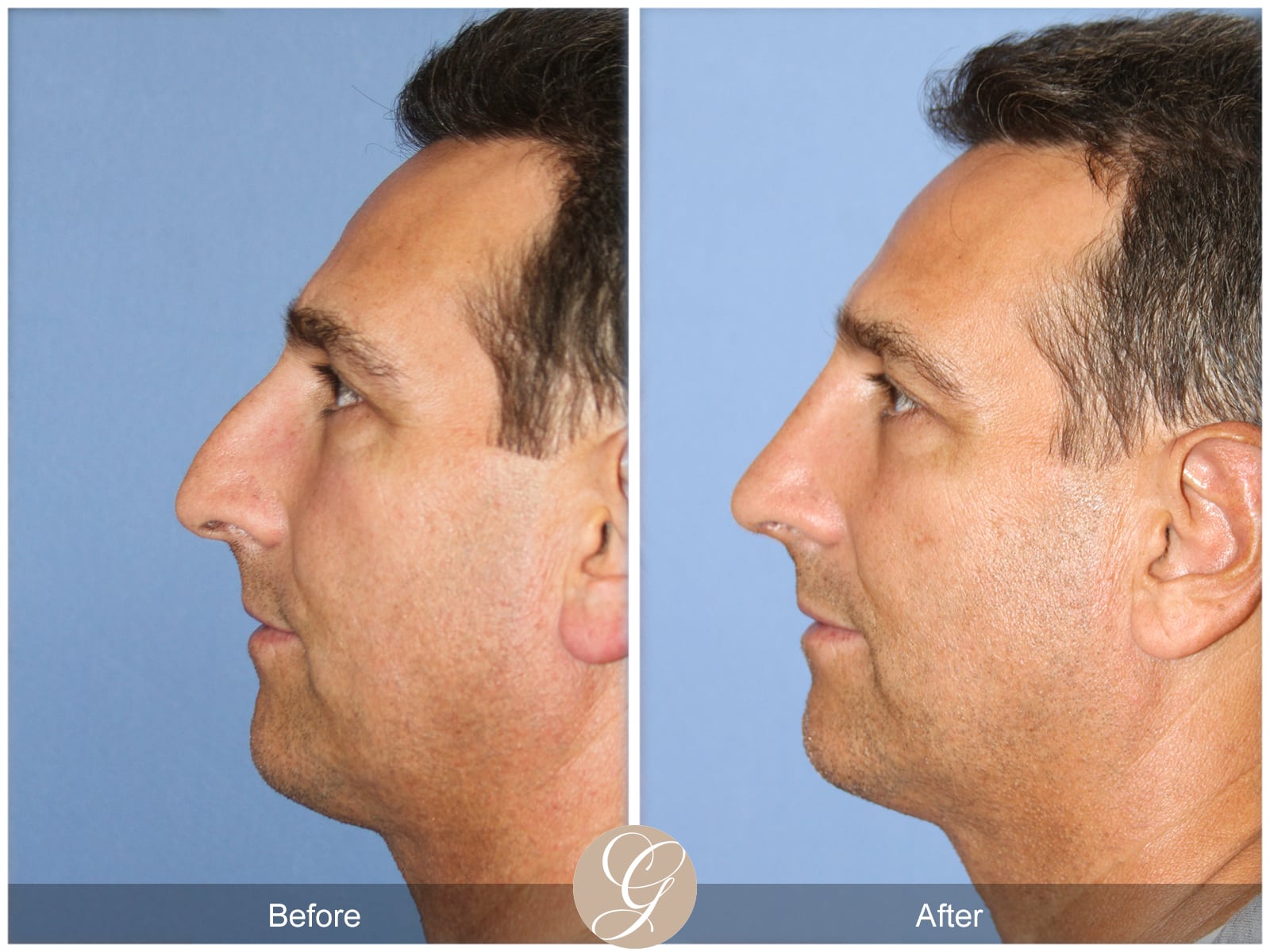 Rhinoplasty 111 Image