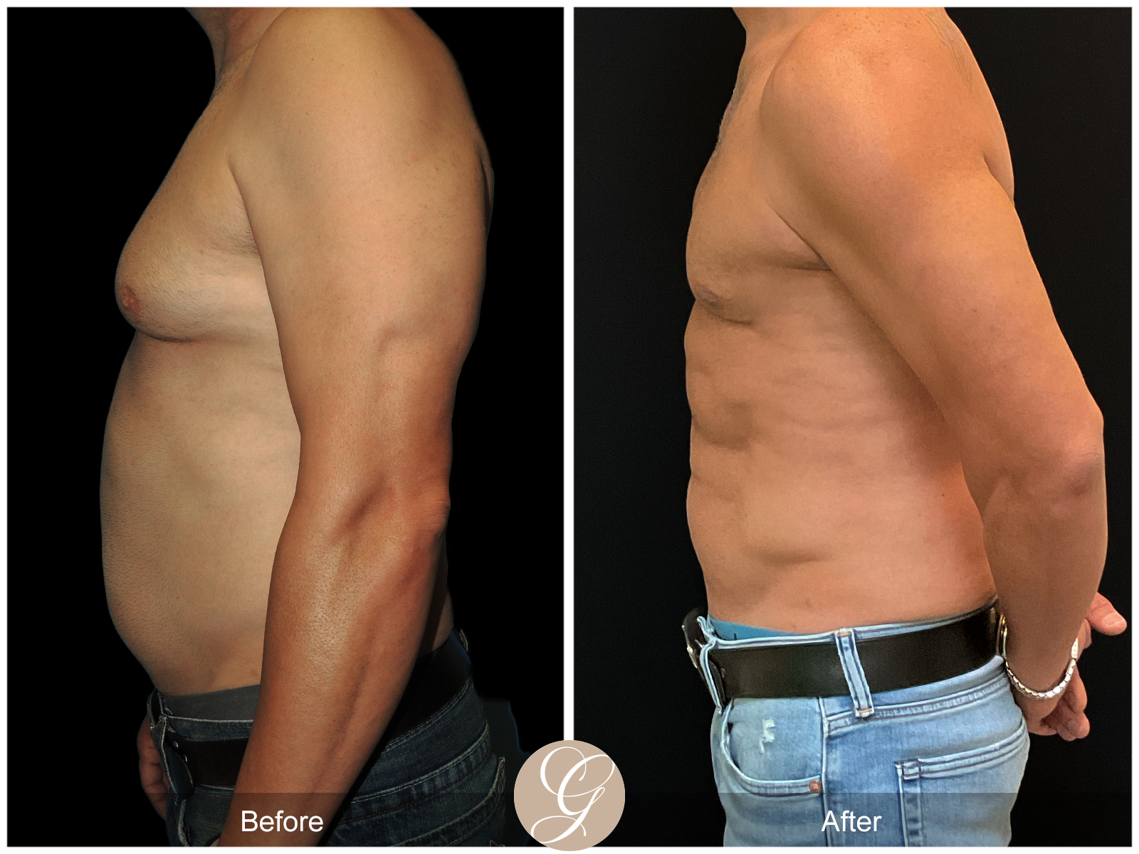 Gynecomastia PT2 Image