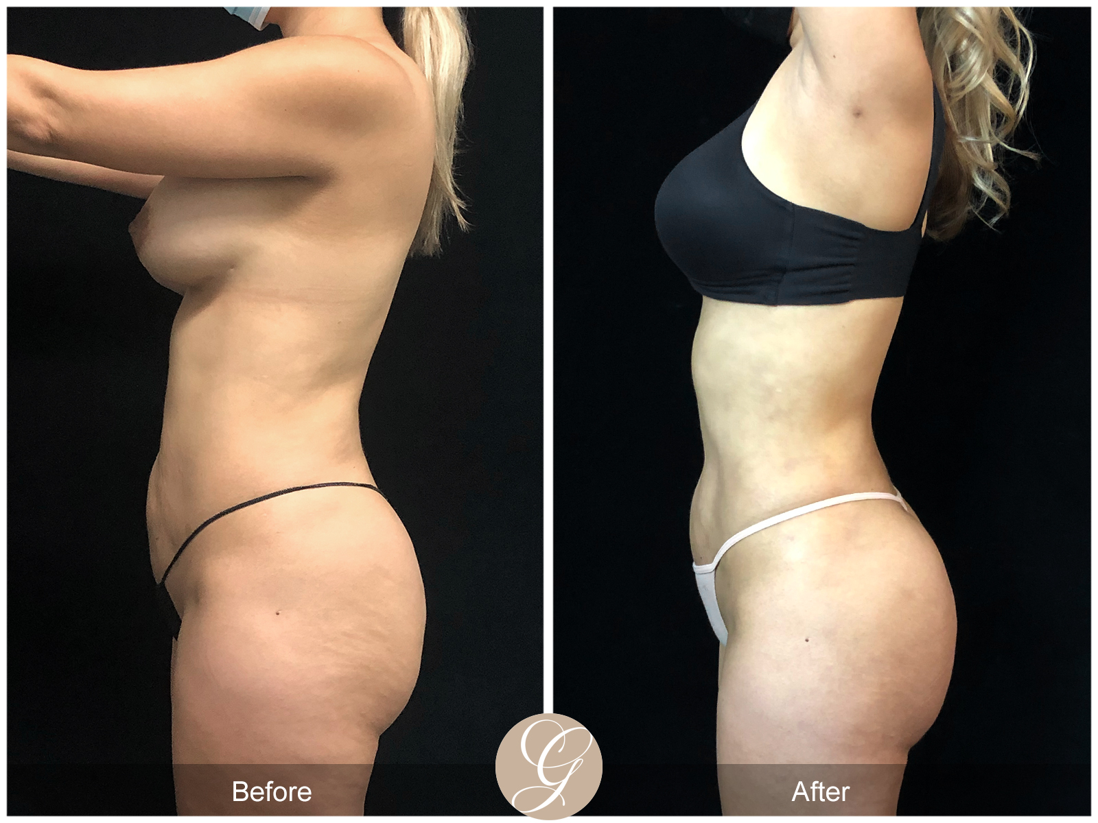 VASER 360 HIGH DEFINITION BODY SCULPTING PT12 Image