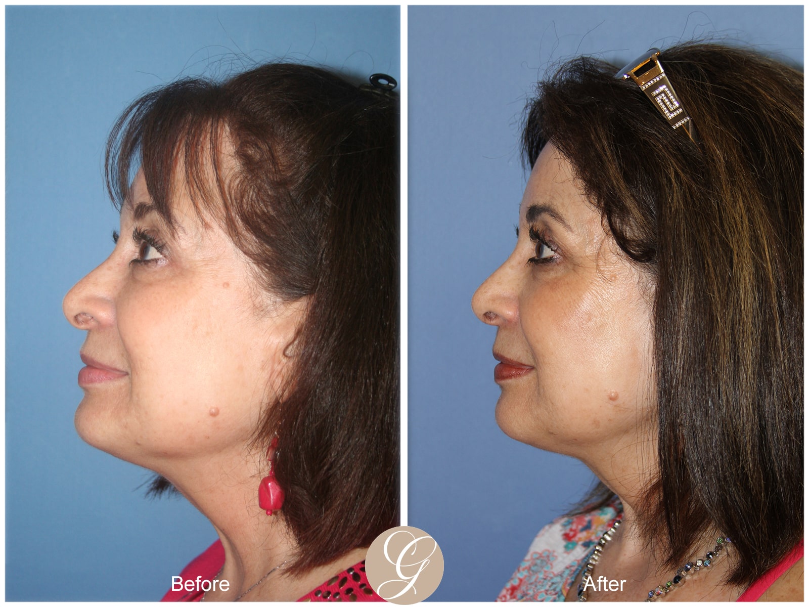 Rhinoplasty 112 Image