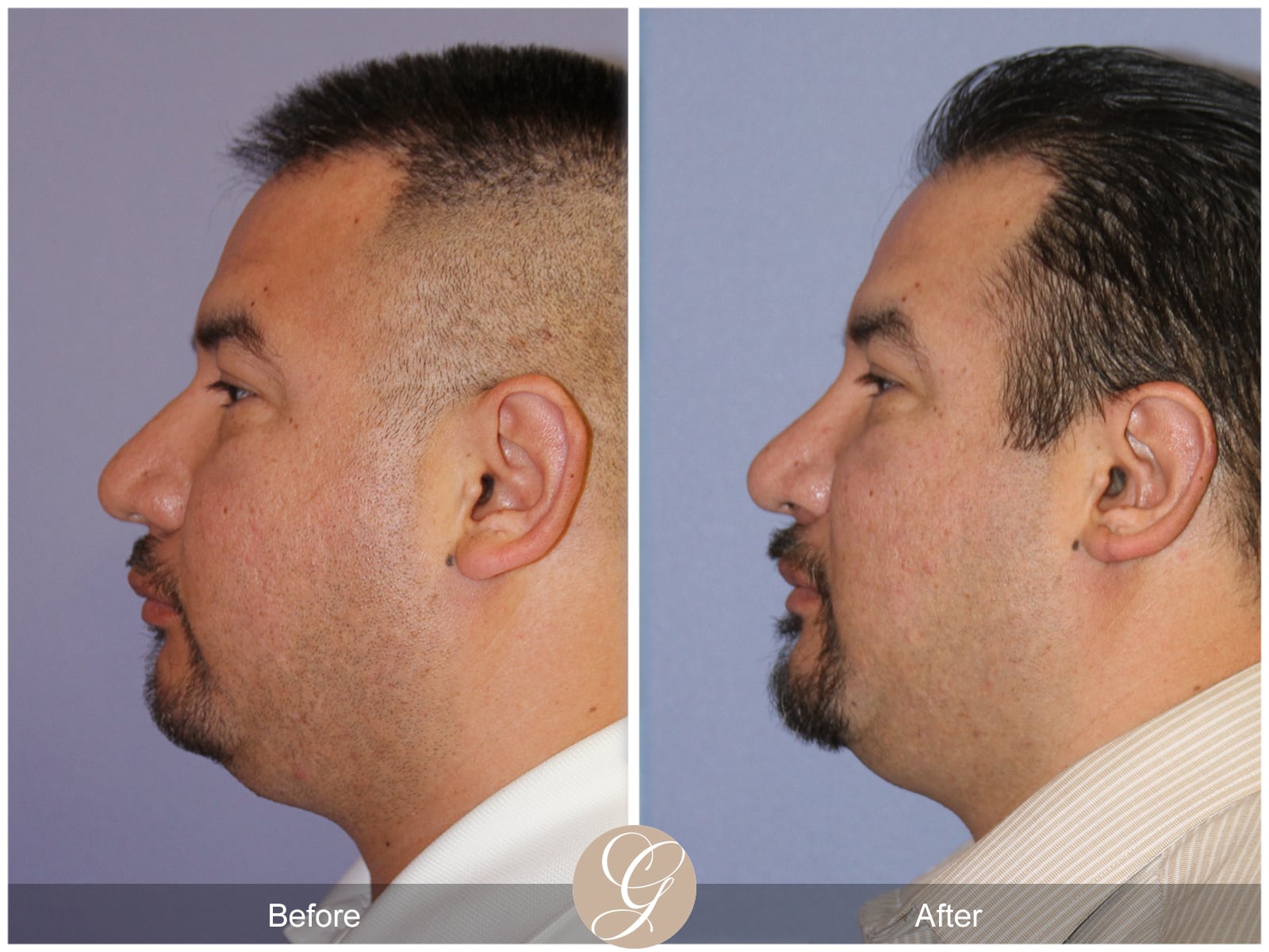 Rhinoplasty 105 Image