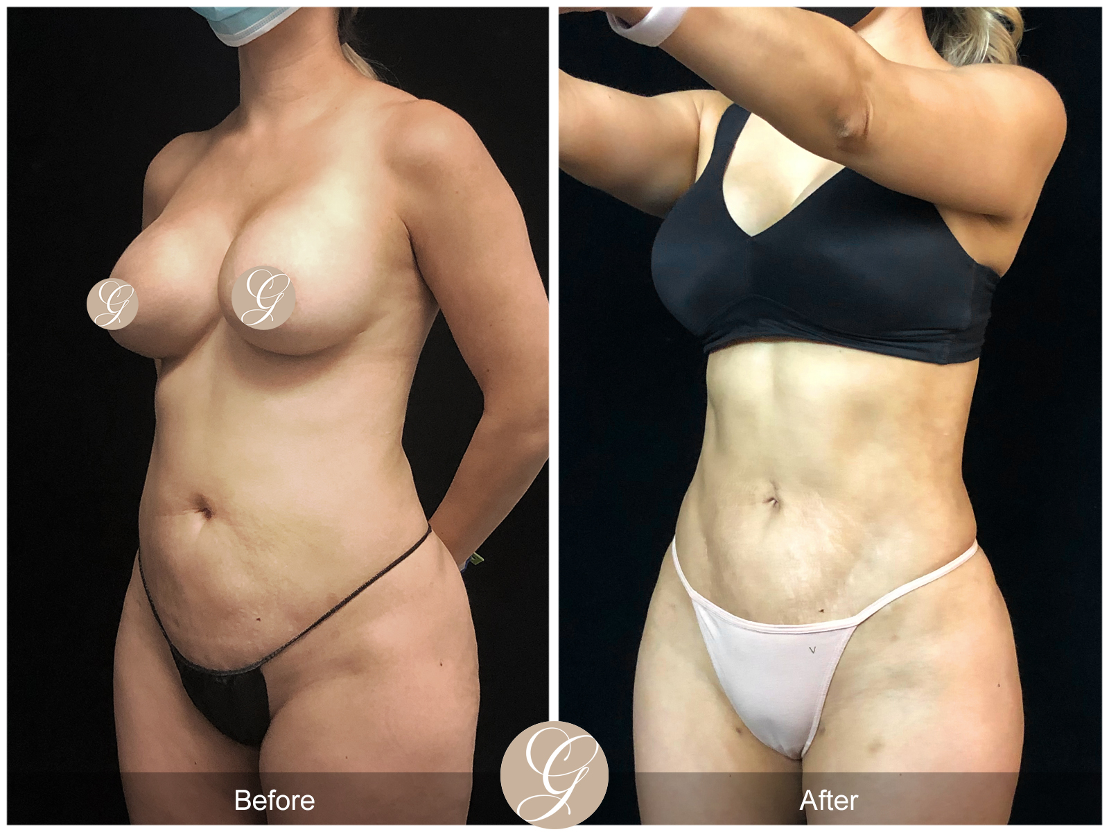 VASER 360 HIGH DEFINITION BODY SCULPTING PT12 Image