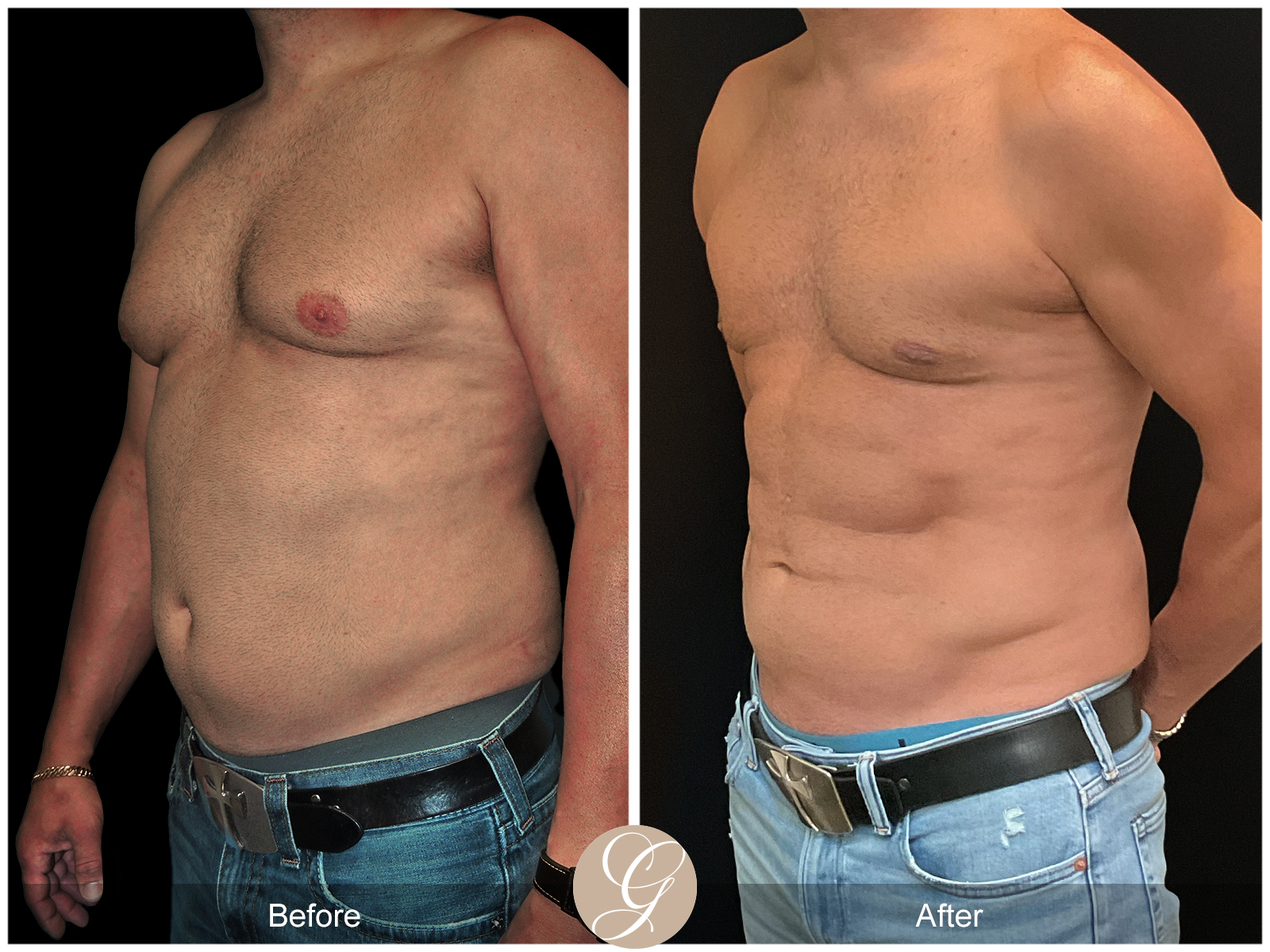 Gynecomastia PT2 Image