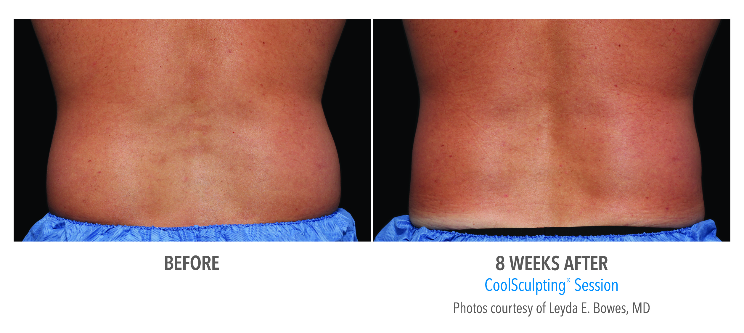 Coolsculpting Case 14 Image