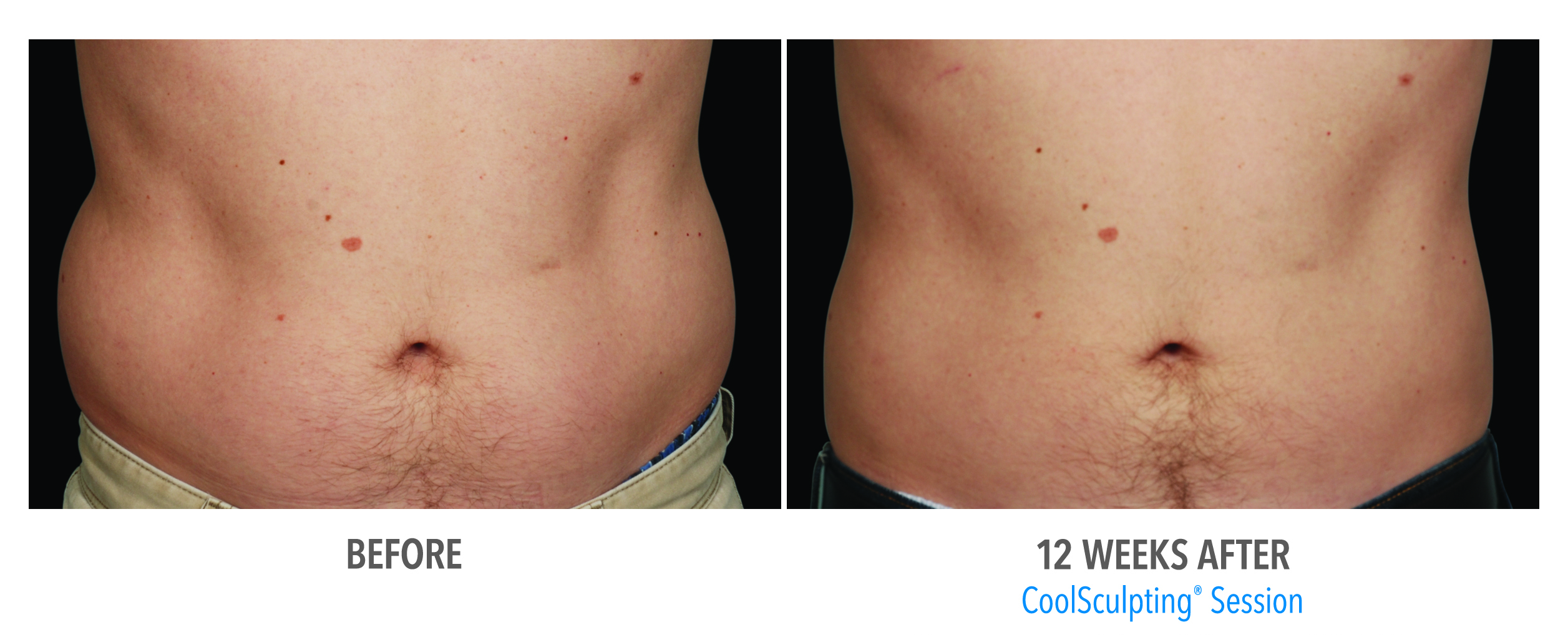 Coolsculpting Case 7 Image