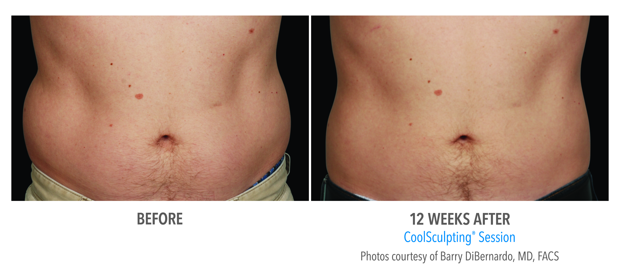 Coolsculpting Case 13 Image