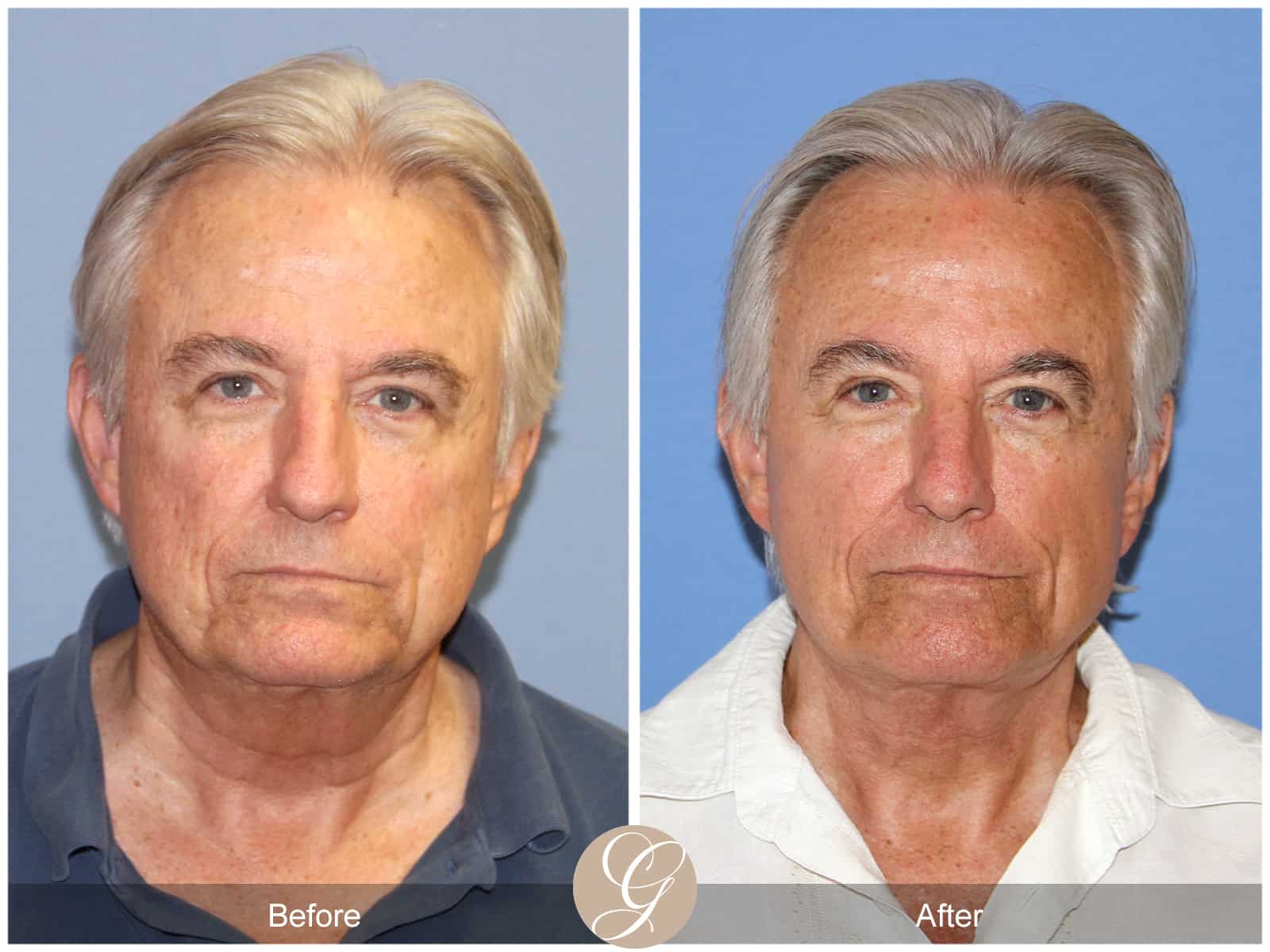 Neck Lift- 409 Image