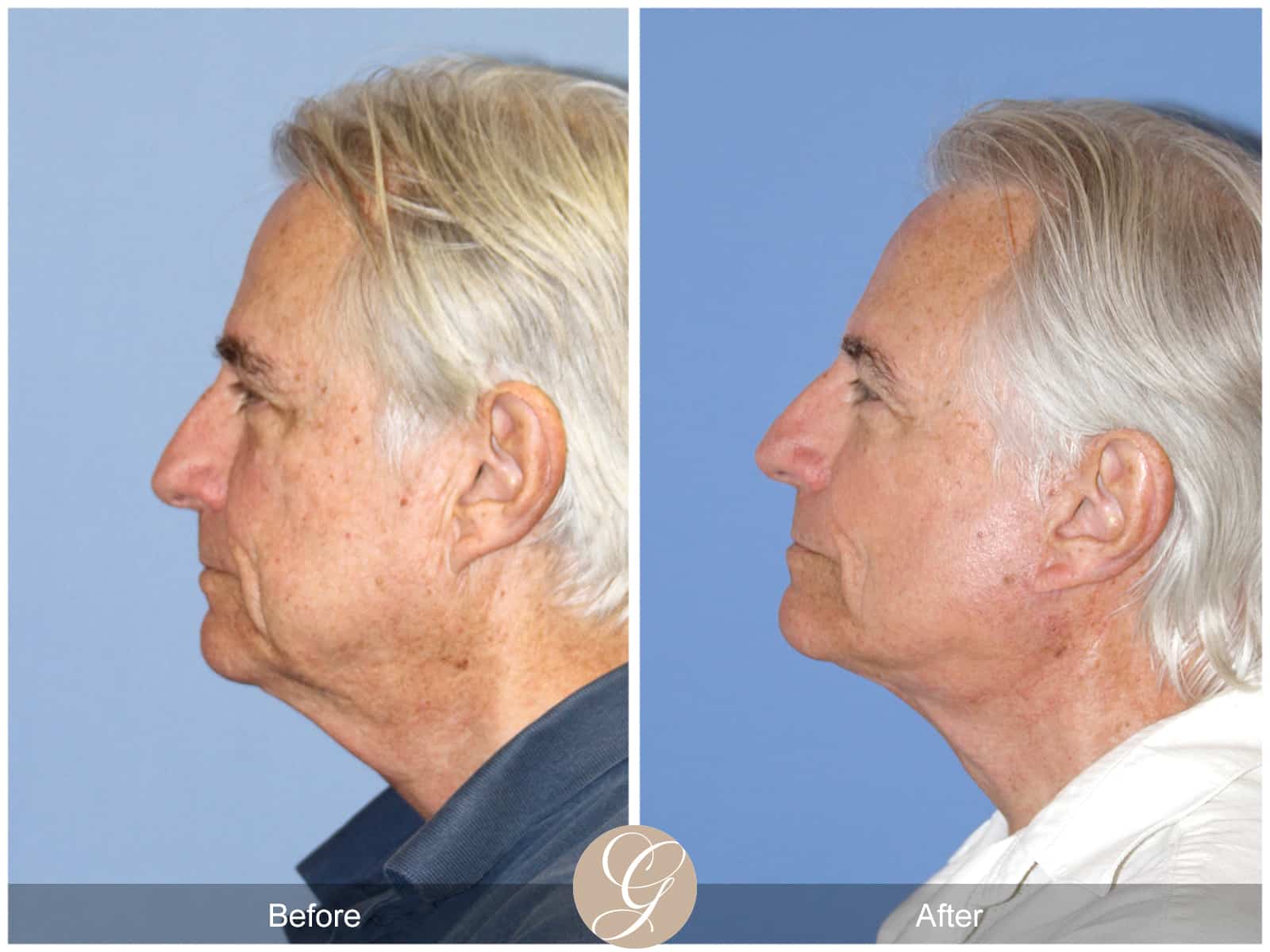 Neck Lift- 409 Image