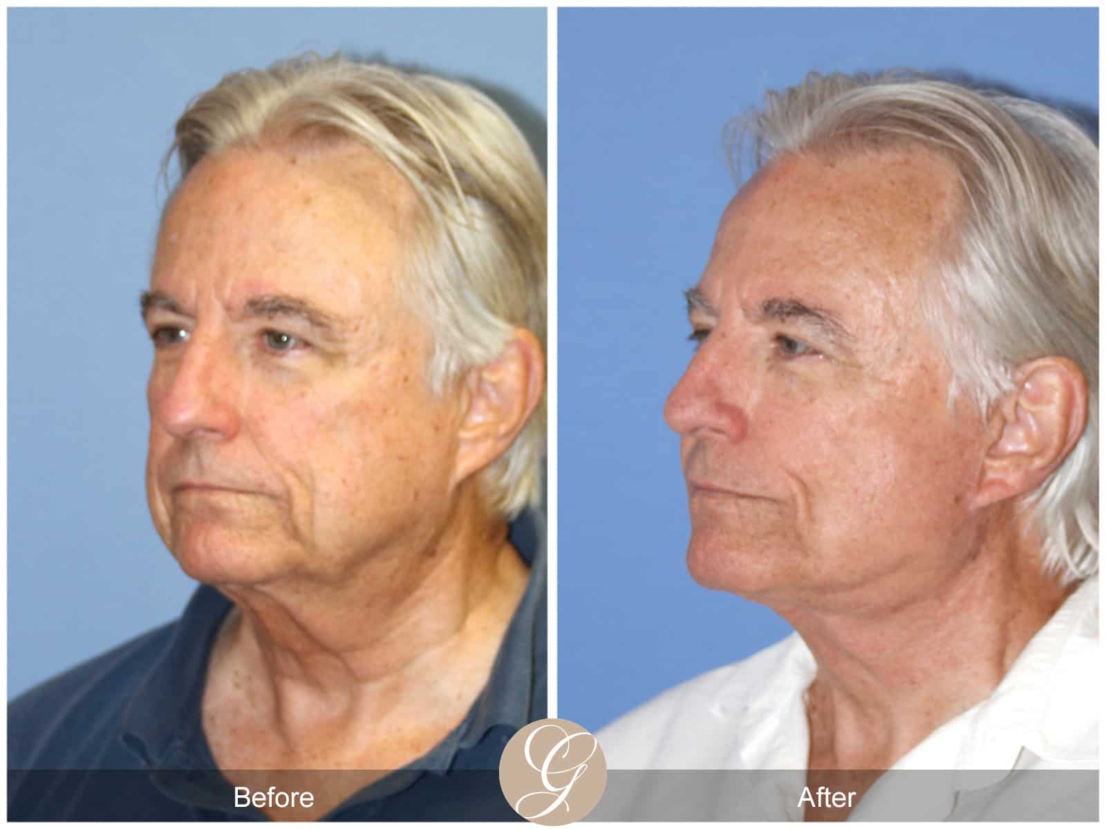 Neck Lift- 409 Image